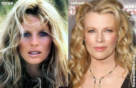 Did Kim Basinger Have Plastic Surgery Botox Injections