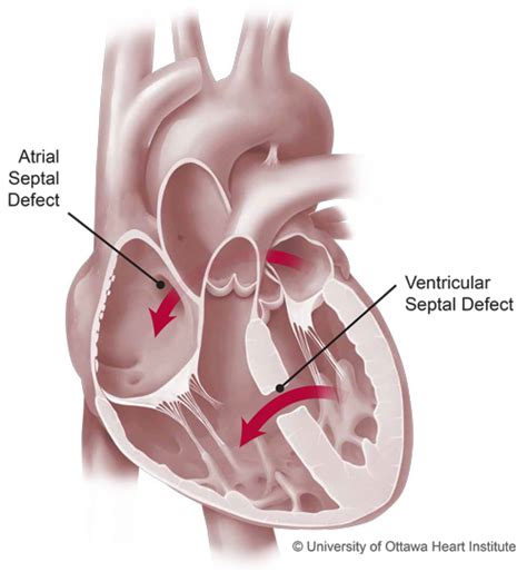 adult congenital heart defects ottawa heart institute