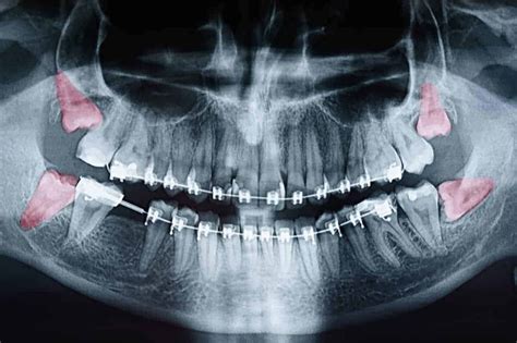 Wisdom Teeth Extractions Georgia South Oral And Maxillofacial Surgery
