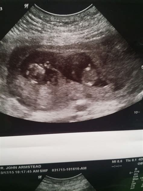 11 weeks pregnant ultrasound twins
