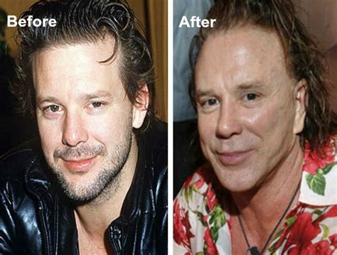 16 Famous Celebs Who Opted For Plastic Surgery And Regretted It