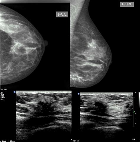 todo sobre la ecografia de mama  mamografia