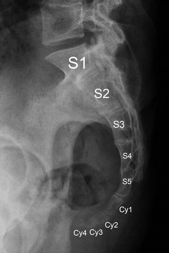 sacrum anatomy xray