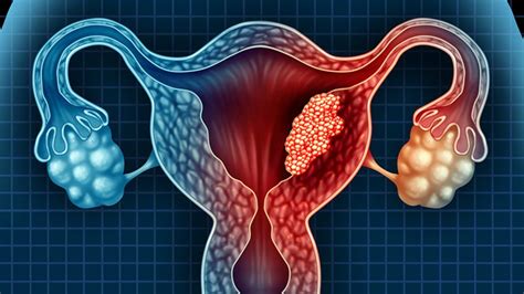 uterine cancer warning signs to watch for