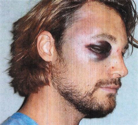 gabriel aubry s face battered and bruised after melée with