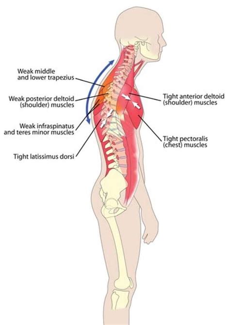 17 Best Images About Back Pain On Pinterest Si Joint