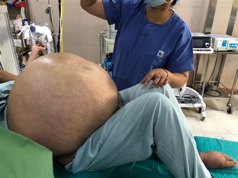 doctors in india remove world s largest ovarian tumour from woman