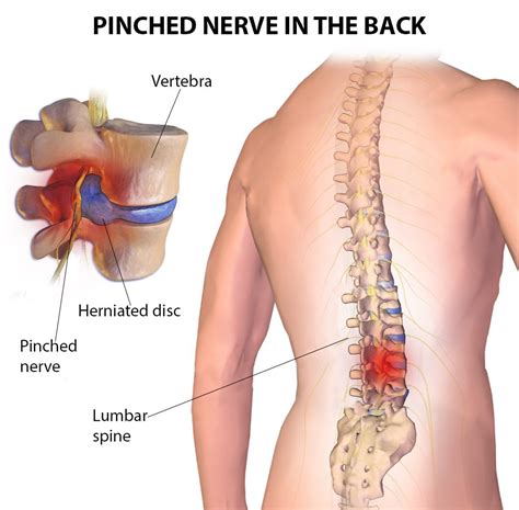 pinched nerves specialists  nyc  york pain care