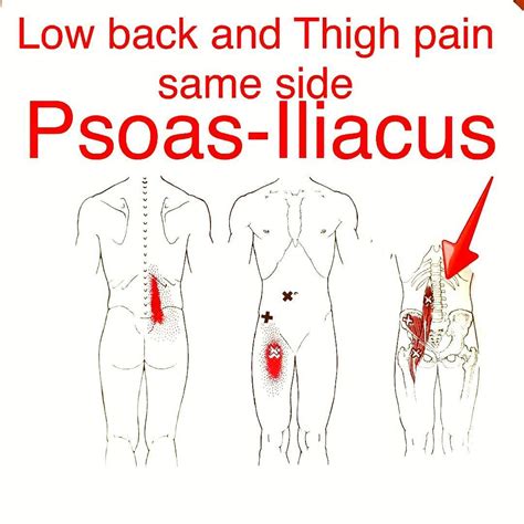 Hip Flexor The Iliopsoas Muscles Or Primary Hip Flexors Are Commonly