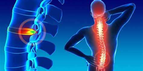 hernia de disco fisioterapia saiba mais sobre  assunto itc vertebral