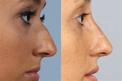 nose shaping  surgery  nose filler dr brett kotlus cosmetic