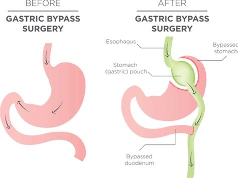 Success With Modified Ercp In Gastric Bypass Patients