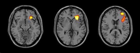 adolescent brain develops differently  bipolar disorder yalenews