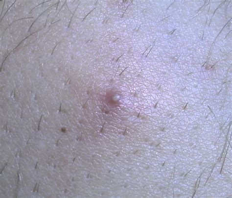 ingrown hair or herpes how to tell