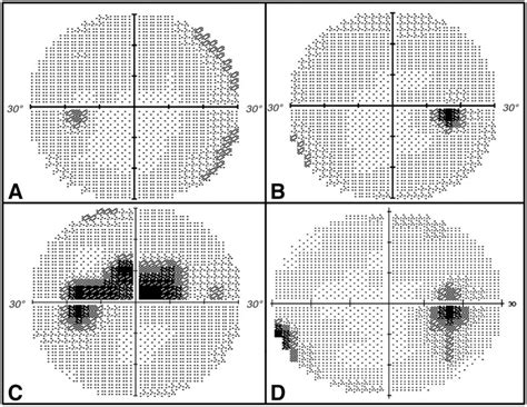 humphrey visual field   sita standard reveals  normal report