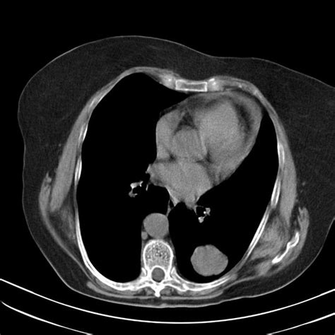 Lung Metastases From Uterine Sarcoma Radiology Case