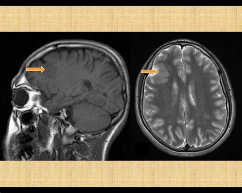 frontal lobe epilepsy  symptoms diagnosis