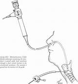Tracheostomy Repeat Smoking Bronchi Trachea Continue Reading Helpful sketch template