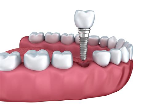 benefits  tooth replacement  time  extraction