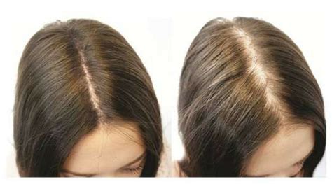 female pattern thinning treatment for women clive hair clinics