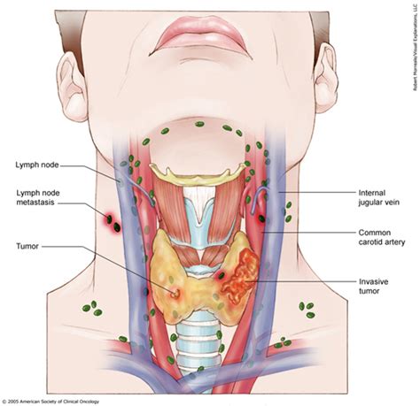 Thyroid Cancer Stages Cancer Net