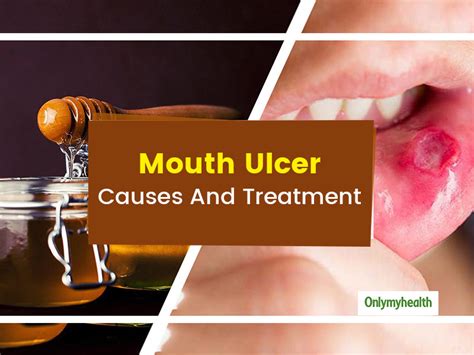 mouth ulcers try these home remedies to get rid of mouth