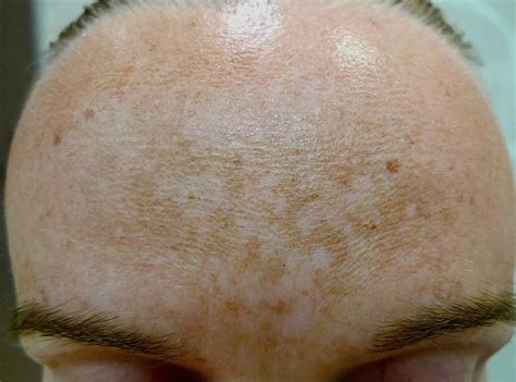 Melasma The Butterfly On Your Face Dr Health Clinic