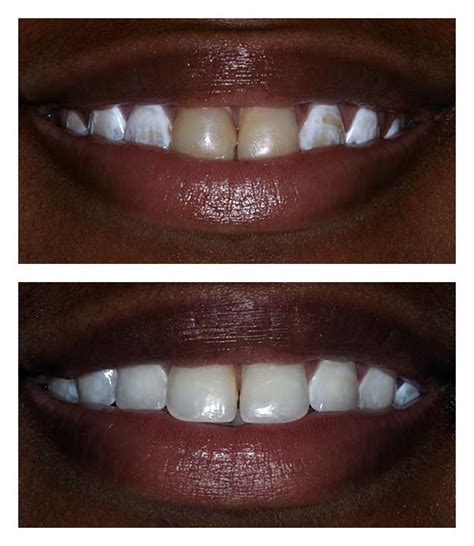 Tooth Contouring Before And After Bartholomew Dentist