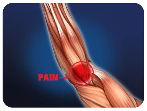 tennisgolfers elbow orlando tendonitis medical massage