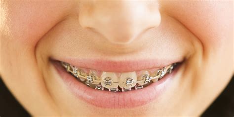 adult braces indicate high self esteem huffpost uk