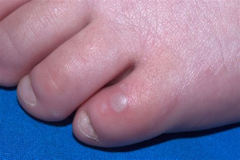 Hand Foot And Mouth Disease Nhs