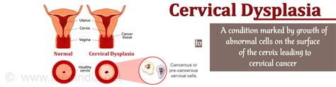 cervical cancer types  symptoms diagnosis treatment