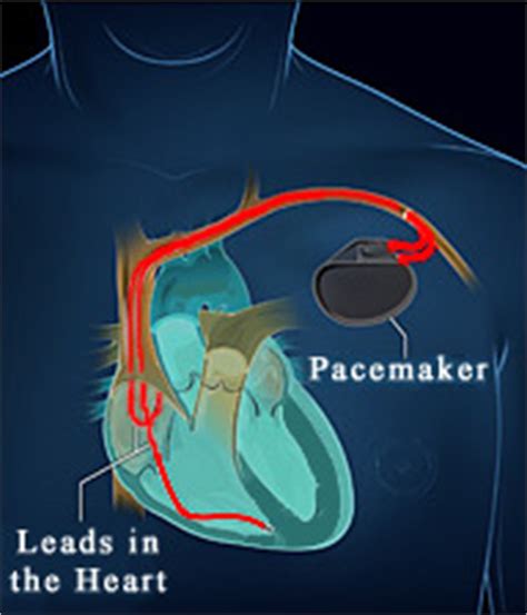 bcs heart services pacemakers