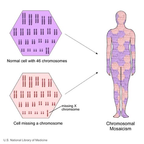 turner syndrome medlineplus genetics