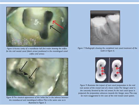 middle mesial canal  mandibular  molars semantic scholar