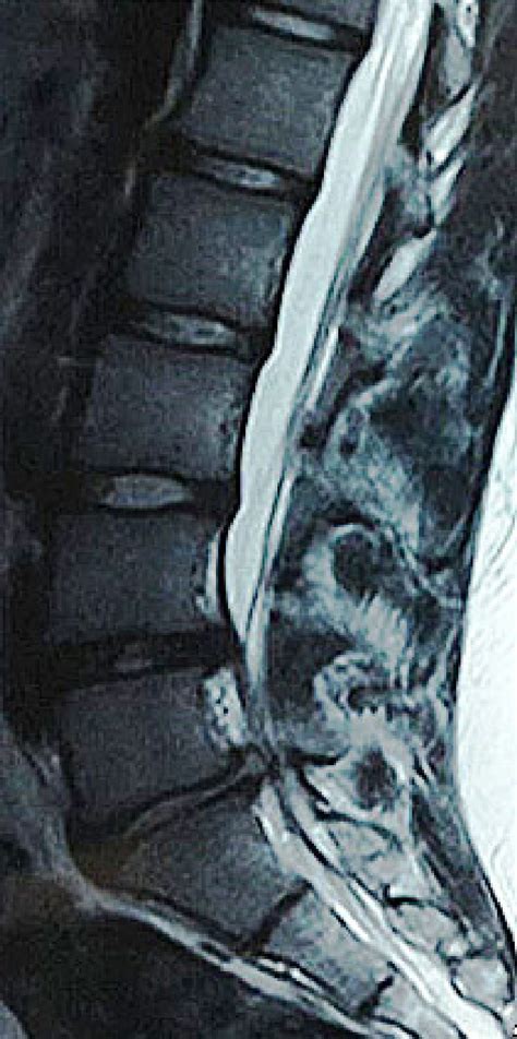 T2 Weighted Sagittal Mri Image Disc Herniation In L4 L5