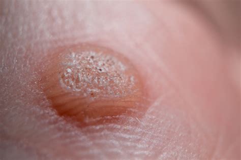 common warts verrucae    skin