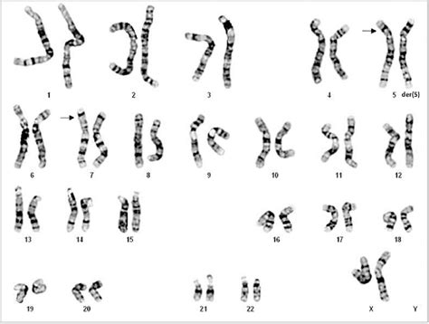 A Karyotype Of 46 Xx Der 5 T 5 7 P15 1 P15 2 In The Fetus The Arrows