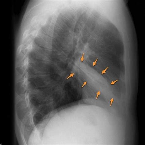 Right Middle Lobe Collapse Radiology Reference Article Radiopaedia