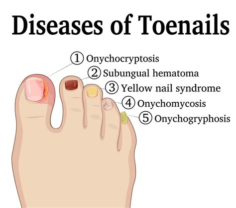 impacted toenail treatment impacted toenail  ingrown toenail