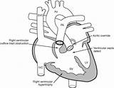 Ventricular Outflow Tract Obstruction Syndrome Right Defect Septal Noonan Left Williams Heart Tetralogy Congenital Uploaded User sketch template