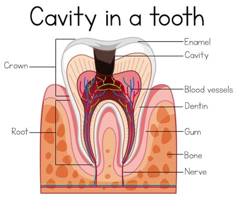 cavidad en  diente vector premium