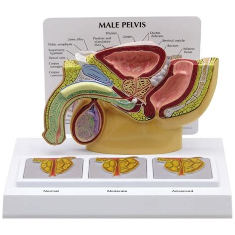 Male Pelvis Section Model With Enlarged Prostates 3551