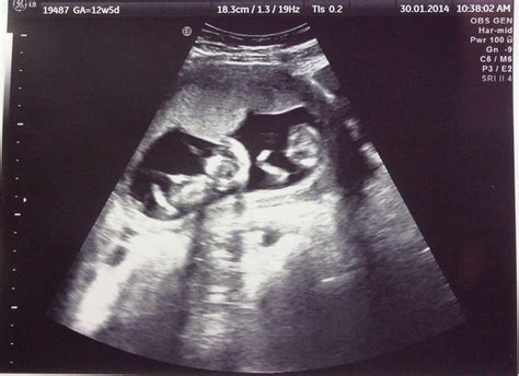 fraternal twins  week ultrasound  week ultrasound baby ultrasound