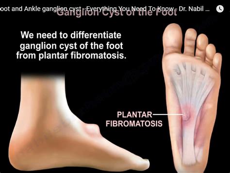ganglion cyst  foot  ankle orthopaedicprinciplescom
