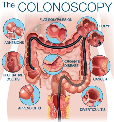 Colonoscopy Bardmoor Gastroenterology