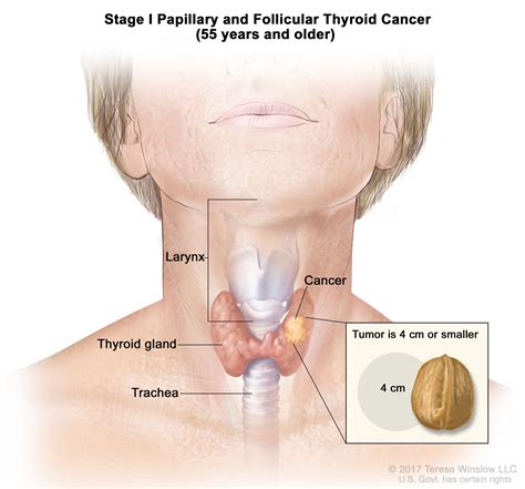 cancerous cyst  neck