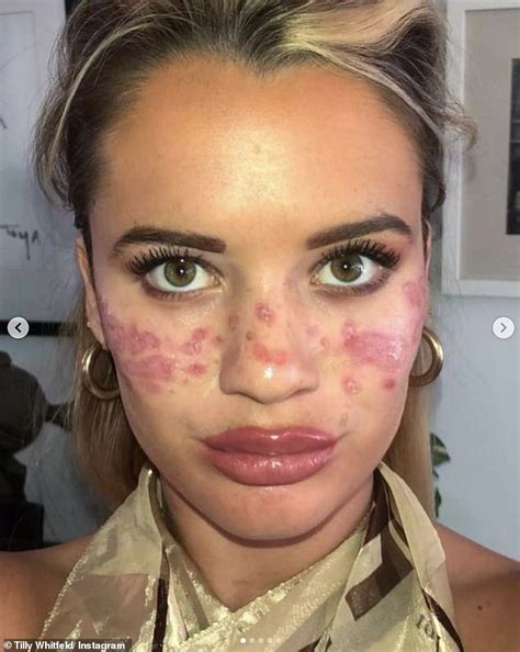 An Influencer Was Left Permanently Scarred And Temporarily Blind After