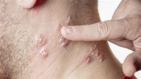 skin infection pictures causes and treatments