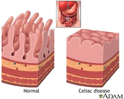 celiac disease medlineplus medical encyclopedia image